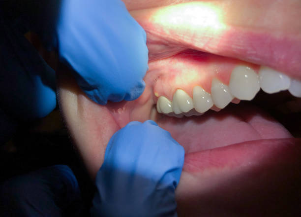 Best Emergency Dental Care for Broken or Chipped Teeth in Riverdale Park, MD